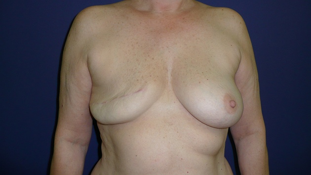 Pacientka po rakovin jet ped plastickou operac prsu. Lkai se pi rekonstrukci rozhodli pro pravu vlastn tukovou tkn.