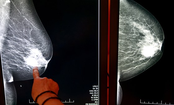 Rakovina prsu je nejastjí nádorové onemocnní en (ilustraní snímek)