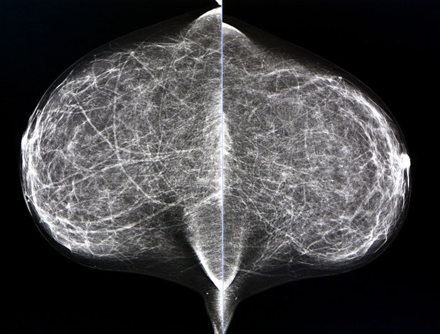 Nekonečné čekání na mamograf. Zlínská nemocnice chce přístroj pro veřejnost