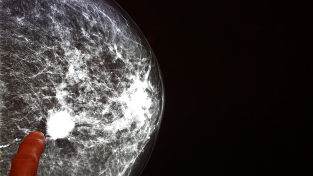 Ilustrační snímek s pozitivním nálezem. Pokud se zjistí závažný problém z mamografie, tak se žena objednává k dalšímu vyšetření v co nejkratším termínu. Nejčastěji se objednává k biopsii, která potvrdí, zda jde o zhoubný nádor.