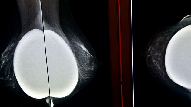 Na mamografu je možné vyšetřit i ženy, které mají implantáty. 