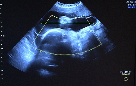 Snímek z ultrazvuku ukazuje jedno z pti dtí, které eká tiadvacetiletá...