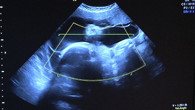 Snmek z ultrazvuku ukazuje jedno z pti dt, kter ek tiadvacetilet Alexandra Kiov. 