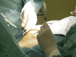 Chirurg naezává prs, ze kterého vyjme expandér - dutý implantát, který slouí...
