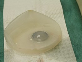 Detail vyputného expandéru neboli dutého implantátu. 