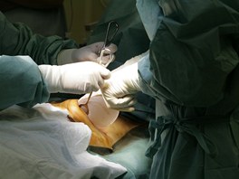 Plastický chirurg vkládá nový silikonový implantát. 