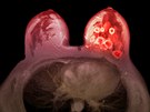 Na snímku z magnetické rezonance je oranovou barvou znázornn nádor prsu u...