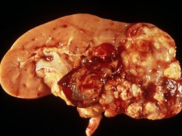 Na snímku je adenokarcinom ledvin (uprostřed). Je to zhoubný nádor, který...