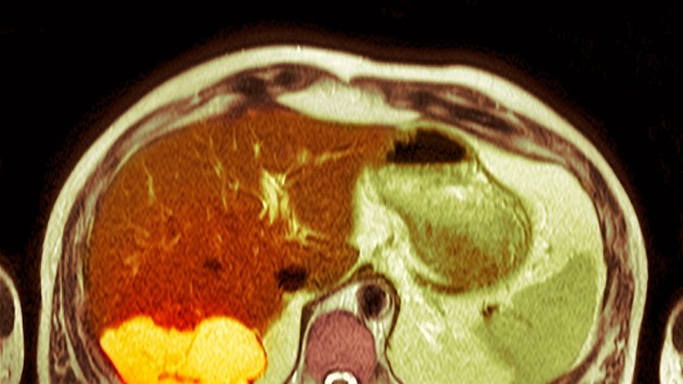 Snímek z počítačové tomografie ukazuje metastázující karcinom jater. Tmavé skvrny na játrech jsou nádory. Jde o druhotnou rakovinu jater, kdy se rakovinové buňky šíří z jiných orgánů, jako je tlusté střevo, žaludek, prsa nebo plíce. 