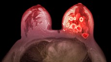 Na snímku z magnetické rezonance je oranovou barvou znázornn nádor prsu u...
