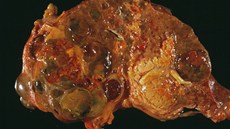 Na obrázku je cholangiokarcinom (to �ervené dole uprost�ed), co� je zhoubný...