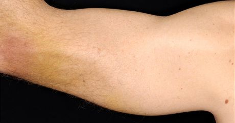 Petrení tricepsu dá o sob krom pekelné bolesti vdt i hematomem.