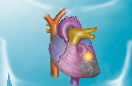 eny i mui v esku podle statistik nejastji umírají na kardiovaskulární choroby (ilustraní snímek)