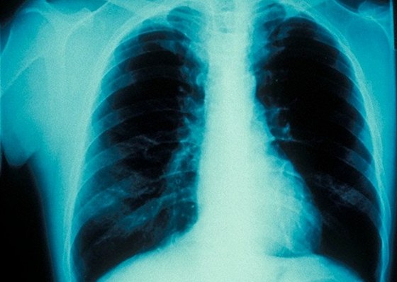 Rentgenový snímek pacienta se silným astmatem. Ilustraní snímek