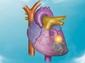 eny i mui v esku podle statistik nejastji umraj na kardiovaskulrn...