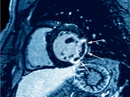 Srdce po infarktu. Snímek z magnetické rezonance devtaticetiletého pacienta...