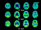 Pozitronová emisní tomografie (PET) mozku, kde je vidět, jak se postupně...