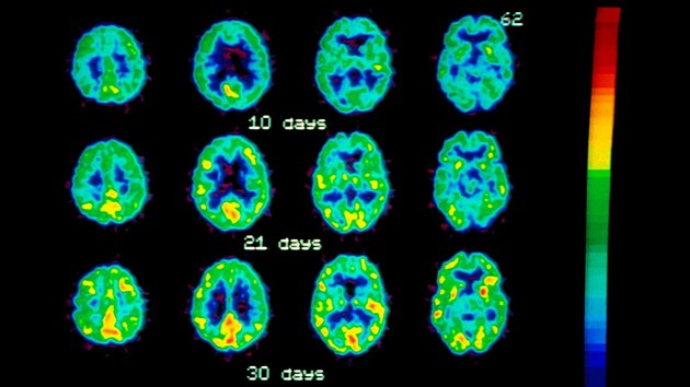 Pozitronová emisní tomografie (PET) mozku, kde je vidět, jak se postupně zvyšuje činnost mozku (žlutě vyznačeno) u alkoholika po abstinenci. V horní části jsou snímky mozku po abstinenci 10 dnů, uprostřed 21 dnů a ve spodní části po měsíci bez alkoholu.