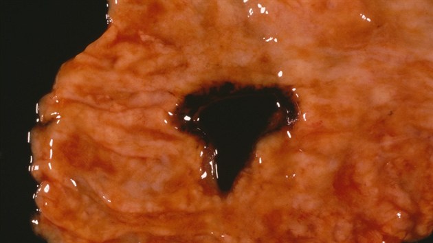 Vředy jsou jednou z častých zdravotních komplikací alkoholiků. Na snímku uprostřed je vidět krvácející žaludeční vřed.