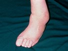 Zdeformovaná noha pacienta s neuropatií.
