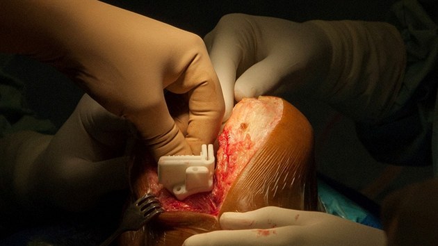 První česká operace, při níž lékaři Vsetínské nemocnice pacientovi vyměnili část kolenního kloubu s využitím speciálních šablon.