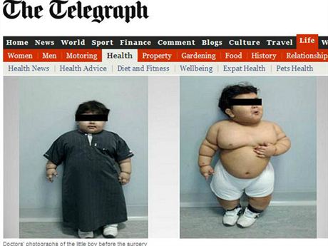 Dvouletý chlapec ped operací váil neuvitelných 33 kilogram.