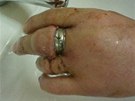 Prsten museli z nateklho prstu sundat hasii
