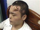 Siao-lien podstoupí u brzy transplantaci nosu, který mu lékai vypstovali...