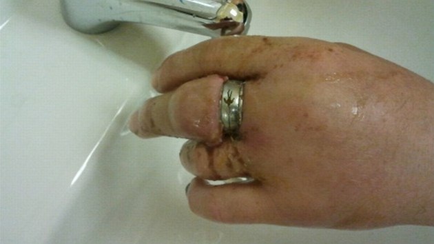 Prsten museli z nateklého prstu sundat hasii