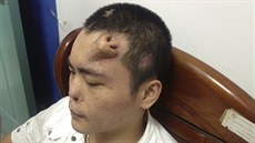 Siao-lien podstoupí u brzy transplantaci nosu, který mu lékai vypstovali...