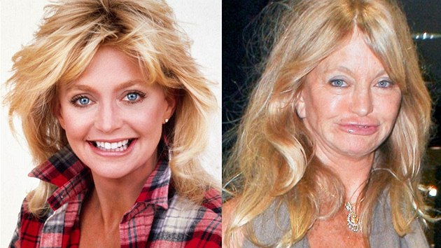 V poslední době se do klubu špatně upravených tváří dostala herečka Goldie Hawnová. Nechala si upravit ret, ale bohužel to nedopadlo nejlépe.