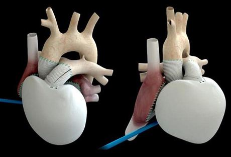 Francouzi transplantovali sobstané umlé srdce, staí mu malá baterie