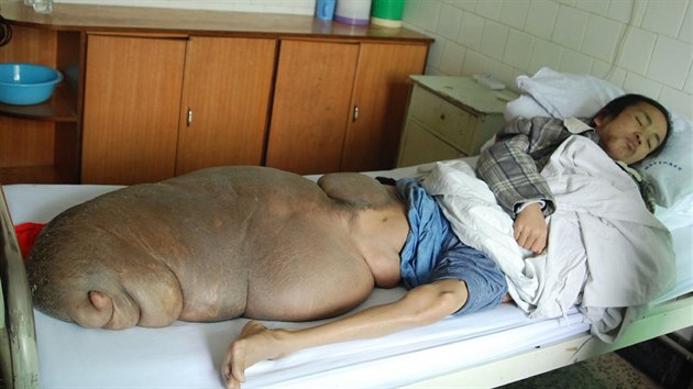 an Chen Zongtao trpl od dtstv nezhoubnm ndorem - neurofibromem. Protoe byl chud, nemohl si dovolit jeho odstrann. Lkai mu ho ve ticeti letech odoperovali. Vil neuvitelnch 70 kilogram.