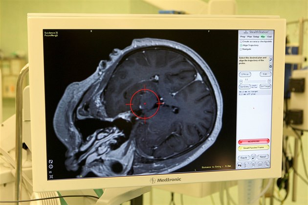 Proti Parkinsonov� chorob� bojují olomou�tí chirurgové unikátní operací, p�i...