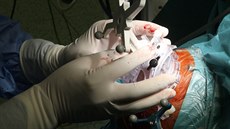 Proti Parkinsonov chorob bojují olomoutí chirurgové unikátní operací, pi...