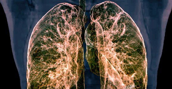Pokud nynjí lidské plíce budou fungovat, co je zatím velkou neznámou, bude to znamenat velkou nadji pro lidi ekající na transplantaci plic. Ilustraní foto
