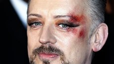 Boy George si nechal na oku udlat umlou ránu jako módní doplnk.