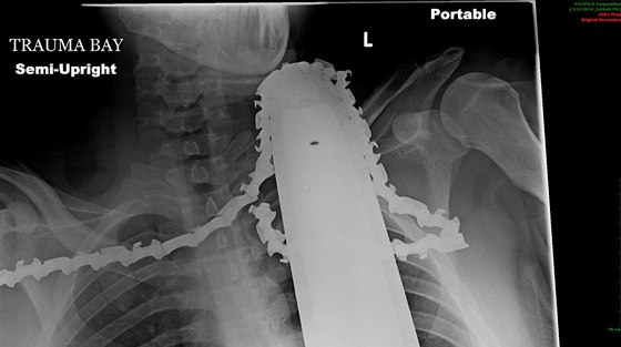 Amerianovi se splaila motorová pila, zasekla se mu do krku a ramene.