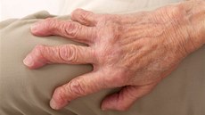 Má se za to, že revmatická artritida postihuje pouze staré lidi, ale její obětí