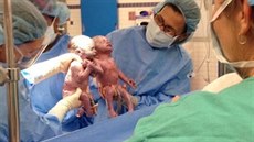 Dvojata Jenna a Jillian Thistlethwaitovy se pi narození drela za ruce (9....