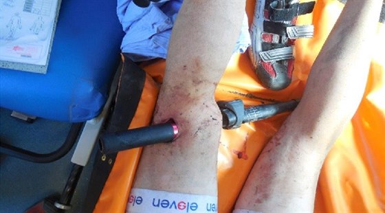 Cyklista upadl na řídítka tak nešťastně, že mu propíchla nohu. Vyndali je...