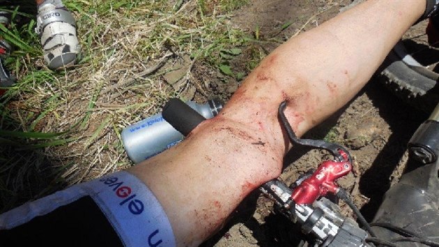 Cyklista upadl na řídítka tak nešťastně, že mu propíchla nohu. Vyndali je lékaři v příbramské nemocnici.  (7.6.2014)