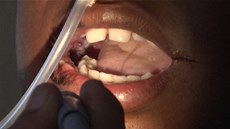 Lékai vytrhali mladíkovi v Indii více ne 230 zub