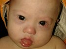 Australský pár nechtl od náhradní matky dít s Downvem syndromem, vzal si jen...