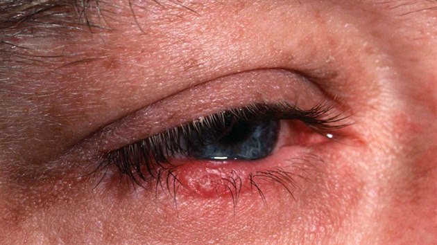 U onemocnění rosacea jsou v ohrožení také oči, které je třeba chránit včasnou léčbou.