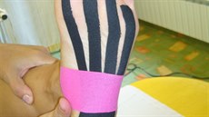 Onemocnní se léí i tejpováním.