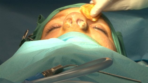 Plastická operace nosu