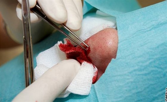 Operace oních víek. Lékaka odebírá vzorek tkán z vystouplé skvrny na nose.