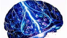 Epileptický záchvat p�edstavuje bou�i v mozku.