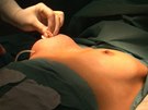 Operace zvtení prsou